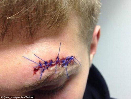 博主：高准翼头部已缝针，没伤及眉骨