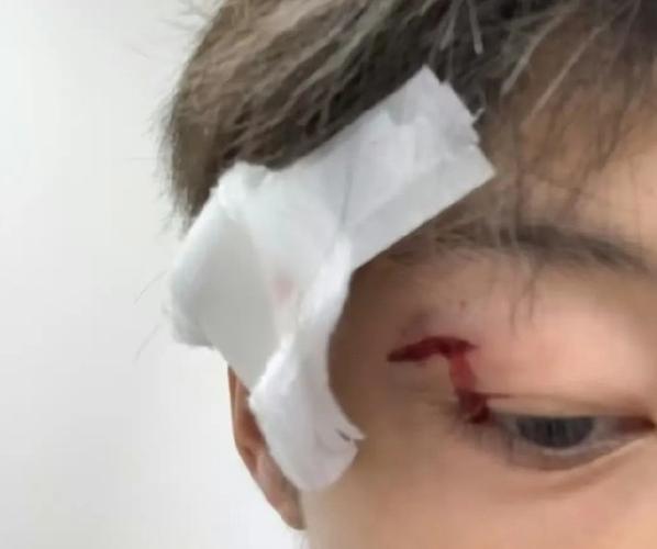 慎入！高准翼眉骨处裂开一道大口子，比赛中头部相撞赛后已缝针